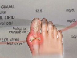 Kolesterol vs. Asam Urat: Memahami Perbedaan yang Penting untuk Kesehatan