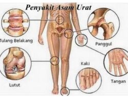 Waspadai Asam Urat Tinggi….?