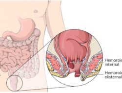 Penyakit Wasir: Ancaman Tersembunyi bagi Dewasa di Usia Produktif